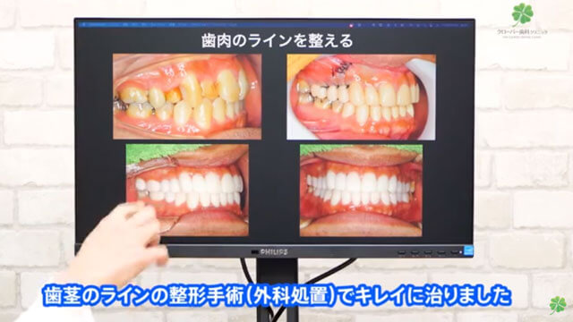 歯茎のラインを整える