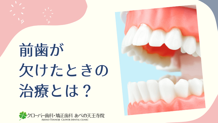 前歯が欠けたときの治療とは？